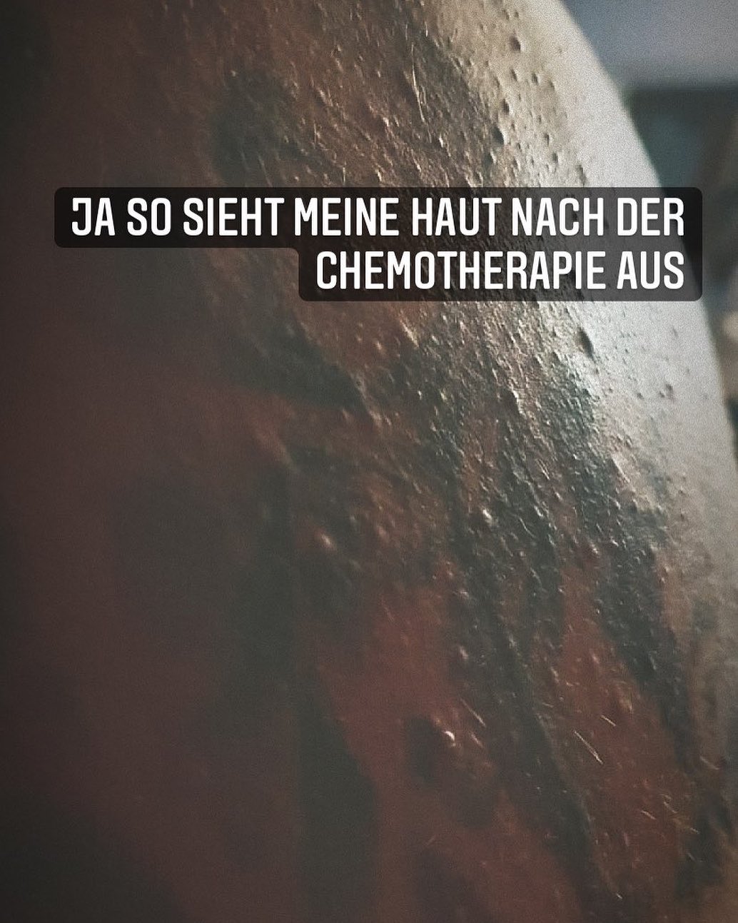 Pizza Funghi..... 
Circa 2-4 Tage nach der Chemotherapie geht’s los ... die Chemo will wieder an die frische Luft .. durch die Haut...
#krebsblogger #krebsisteinarschloch #krebskämpfer #krebskrank #cancer #cancerfighter #lifestyle #lifeisgood #lifeisbeautiful #lifecoaching #lifegoals #lifeofadventure #love #selfie #healthylifestyle #healthy #gesundheit #gesundleben #krank #krankheit #lebensfreude #lebengenießen #lebensqualität #lebedeinleben #lebensmotto #fickdichkrebs #zitate
