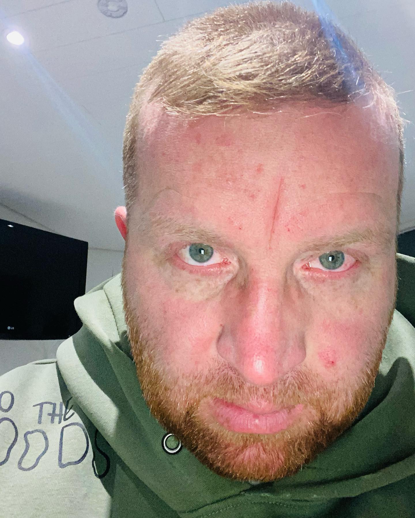 Zu allen schönen Momenten die man mit dieser Krankheit erleben darf und zum Glück auch noch kann, kommen auch solche. 

Angst, Verzweiflung, wie geht’s weiter … Kann ich das morgen noch ? Hilfe wie seh ich grade aus … ich bin jemand anders …. Ich wollte eine Familie .. wollte Glück… nun kommt dieser Schatten und legt sich einfach wie eine zweite Haut darüber … keine Chance …. Hier bitte komm damit klar … 

Was hilft in der Situation? Es zulassen und 3 Tage durchheulen, es ignorieren und dann beim Einkauf an der Kasse zusammenbrechen?…. es hinnehmen wie es ist und versuchen es zu sortieren ?

Keine einfach Sache…. Ich sag mir einfach immer wieder :
2 Buchstaben entfernt …

——-un HEILBAR—— ich möchte leben und kämpfe…. Bergab geht’s natürlich schneller als hoch … aber ich klettere bis zum Gipfel und lache dich aus du hässlicher Berg …. 

🤘🏻😀😀😀 wir geben niemals auf … nennt und Palliativ Unheilbare … nennt uns wie ihr wollt. 

Für mich habt ihr alle gewonnen 🙏👌👍 

#krebsblogger #krebsisteinarschloch #krebskämpfer #krebskrank #cancer #cancerfighter #lifestyle #lifeisgood #lifeisbeautiful #lifecoaching #lifegoals #lifeofadventure #love #selfie #healthylifestyle #healthy #gesundheit #gesundleben #krank #krankheit #lebensfreude #lebengenießen #lebensqualität #lebedeinleben #lebensmotto #fickdichkrebs #zitate#darmkrebs