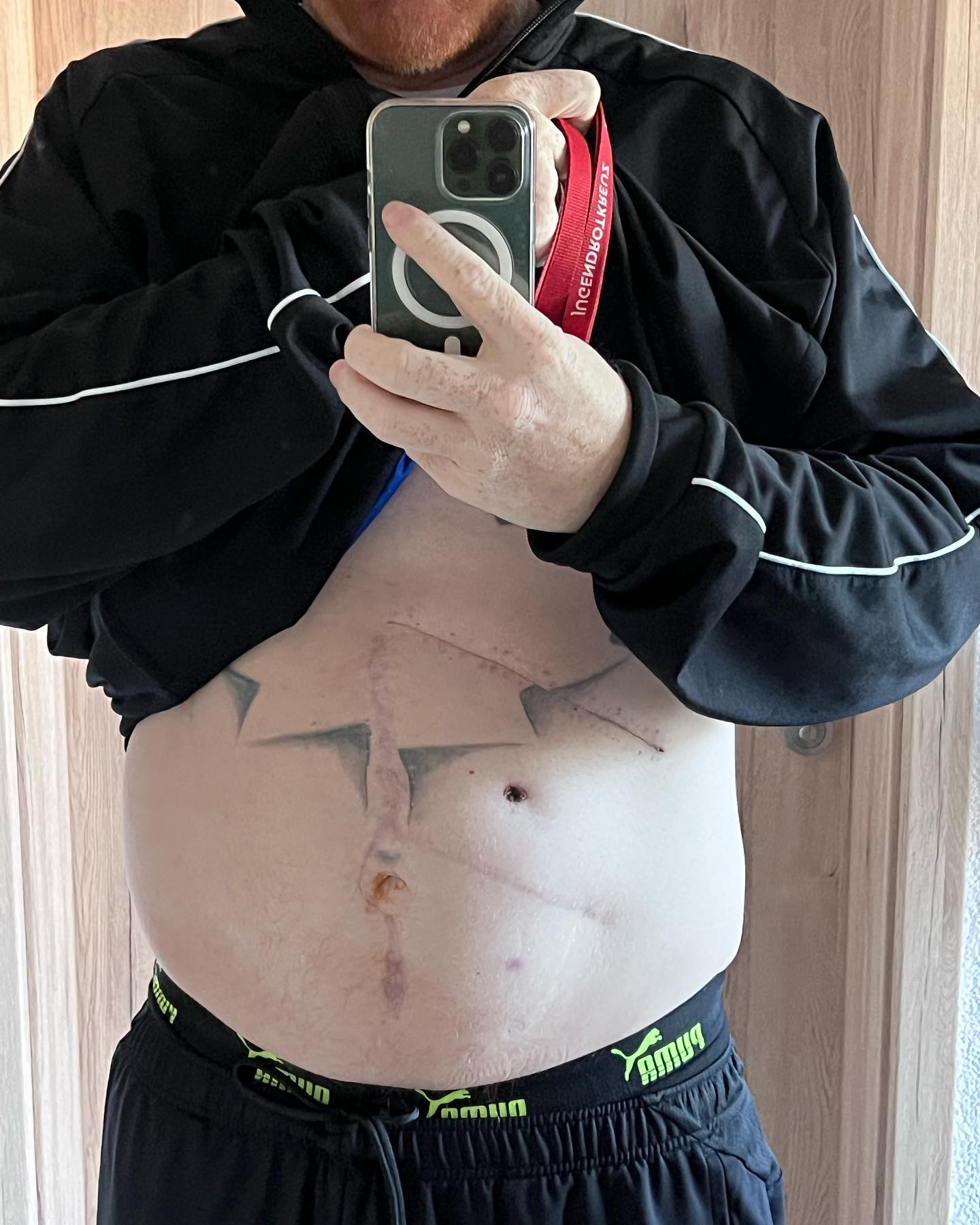 Mein schönes Canada Tattoo 😂✌️

Bisher verheilt alles gut. Aber hier sieht man mal die Ausmaße. Ein paar heftige Schnitte. Der letzte ist noch am verheilen. Das dauert einfach seine Zeit.

Aber ich bin mega stolz auf meinen Körper, dass ich schon wieder durch die gegen laufe. Wenn man überlegt das ist keine 3 Wochen her.

Die bauchmodel Karriere ist natürlich gestrichen. Und meinen Sixpack haben se auch rausgemacht. Bisschen geschwollen noch an manchen Stellen. Aber es wird 😇

#krebsisteinarschloch #darmkrebs#krebskämpfer #krebskrank #cancer #cancerfighter #lifestyle#cancerblogger #lifeisgood #lifeisbeautiful #lifecoachin #palliativ #darmkrebs#lifeofadventure #love #selfie #healthylifestyle #healthy #gesundheit #gesundleben #krank #krankheit #lebensfreude #lebengenießen #lebensqualität #lebedeinleben #lebensmotto #fickdichkrebs #zitate 
#fckcancer